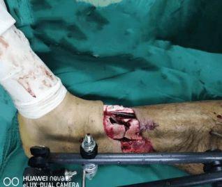 常德骨科医院成功完成一例小腿完全离断伤再植手术