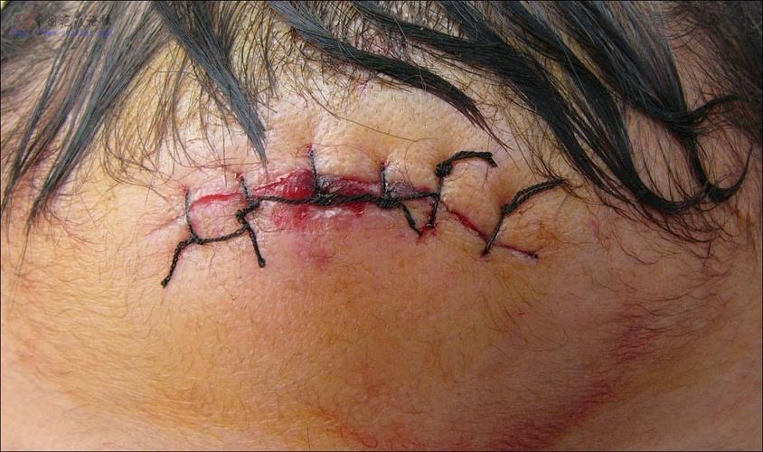 伤口长度已经超过脸部的三分之一,恐怕以后留的疤痕会很明显.