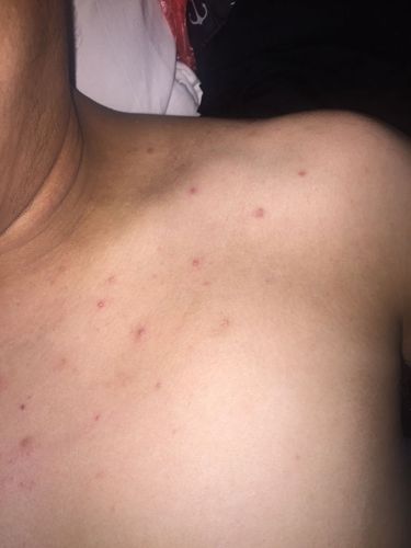 我身上起的什么疙瘩,好几个月了,不痛不痒,挤一下有点疼