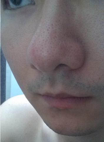 鼻子上黑头粉刺毛孔粗大