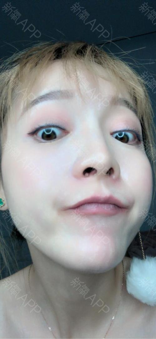 做下巴后,因为看着还不错,所以又去做了双眼皮,开眼