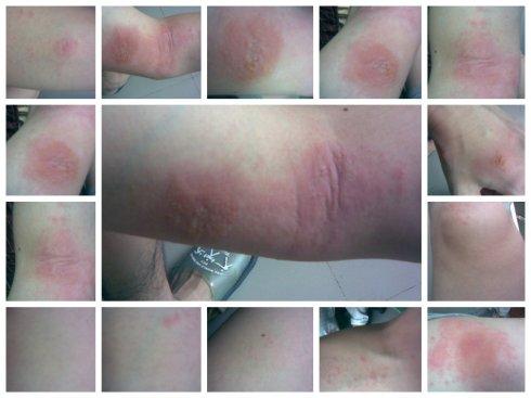 千辛万苦奇痒难耐,终于熬到漆疮第六天(有图有真相)