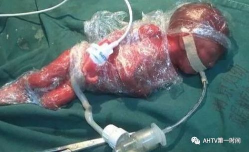 【快线热点】孕妇5个多月早产,体重仅1.1斤宝宝奇迹存活!