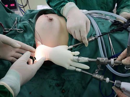 其它 朝气蓬勃的内蒙单孔腹腔镜团队 写美篇 单孔腹腔镜阑尾切除术