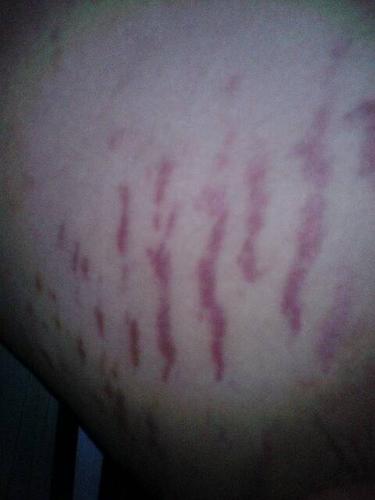 大腿两边有红色的一条线淤血什么问题