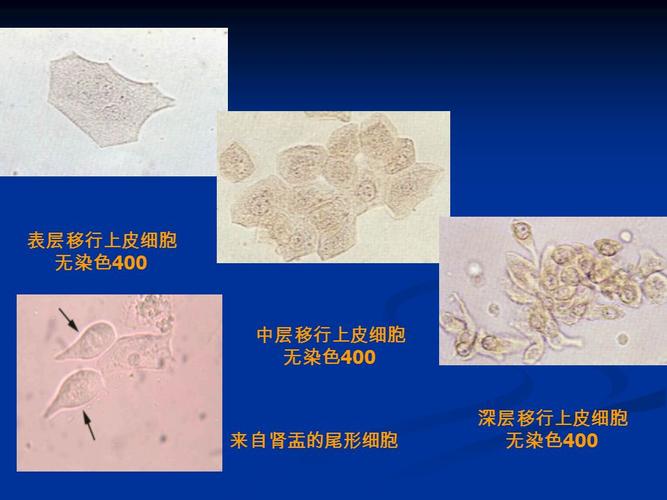 移行上皮细胞 来自肾盂,输尿管,膀胱 来自肾盂,输尿管,膀胱 表层