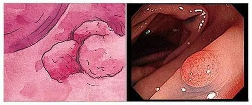 息肉有这几个种类,切不切除靠什么决定?