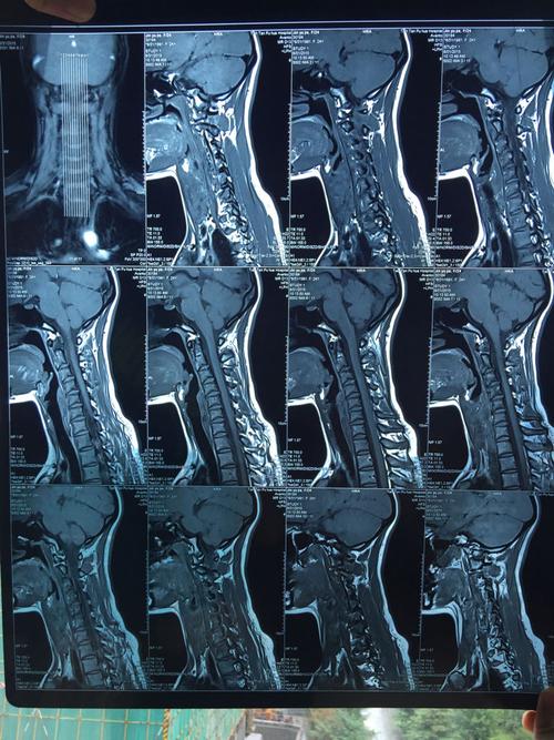 颈椎3456向后轻微突出,前几天有呕吐,很严重吗?今天刚照的核磁.