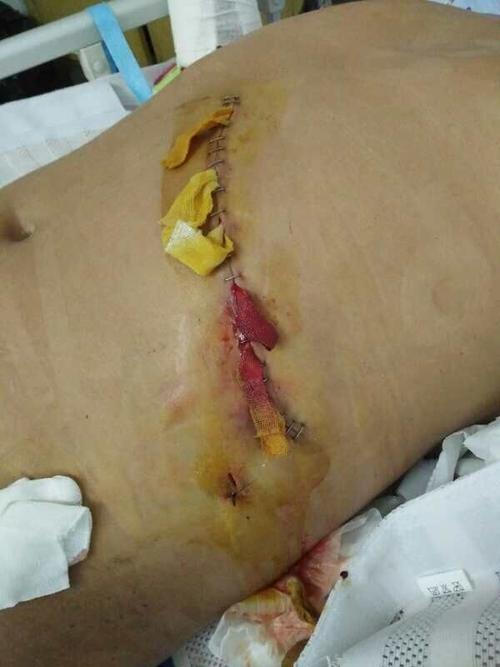 工伤被骗出院,如今双手粉碎性骨折,还未治疗,脾脏被切