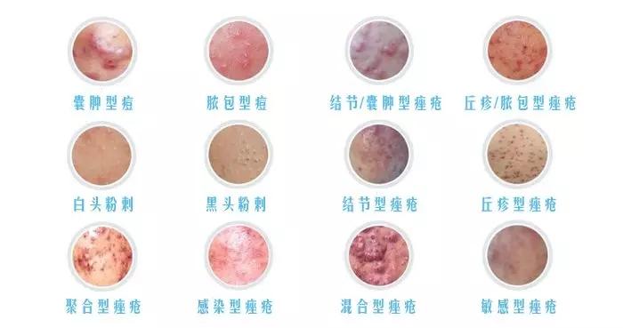 3,生活习惯:喜吃肥腻,辛辣刺激性食物,熬夜,抽烟,喝酒 2,丘疹型痘