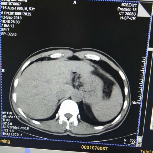 肝囊肿微创治疗