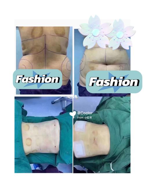 腰腹抽脂前后对比_吸脂_腰腹_吸脂的话题_减肥_减肥