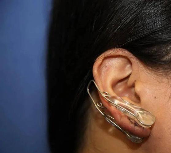 打耳洞后为啥会长小疙瘩