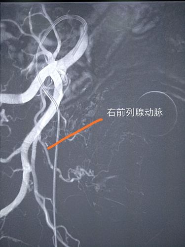 心内科沈阳主任的支持,促成本市首例前列腺动脉栓塞术(pae)的诞生!