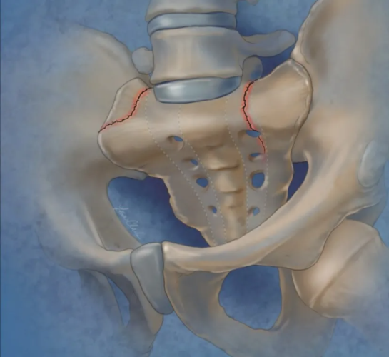 王建东:腰髂固定在骶骨骨折中的应用,你了解多少?