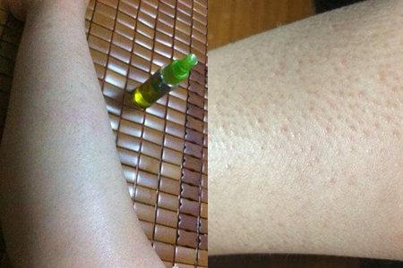 图患上了鸡皮肤可以激光脱毛吗原来还有这些小知识