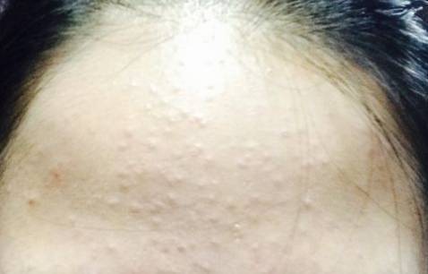 什么痤疮反反复复不好的主要原因之一,一些明显的痤疮消灭之后,微粉刺