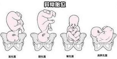 3,横位:胎儿躺在肚子里,这是造成肚子圆的可能原因之一.