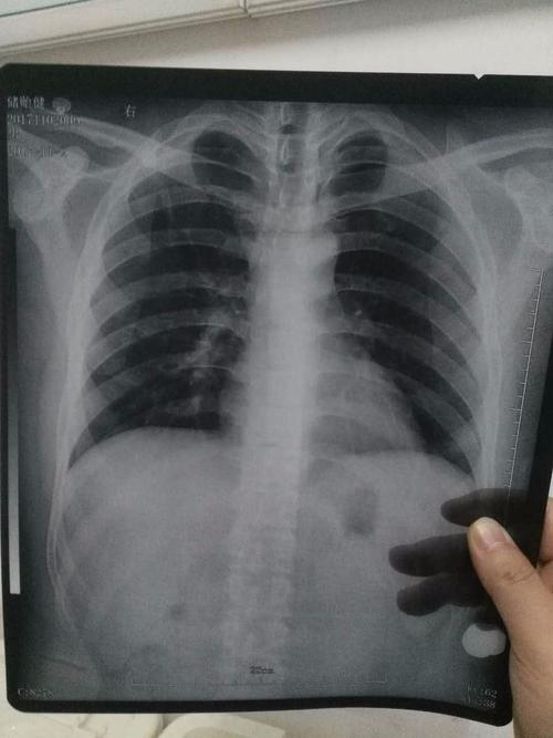 胸透照片帮忙看一下有没有问题