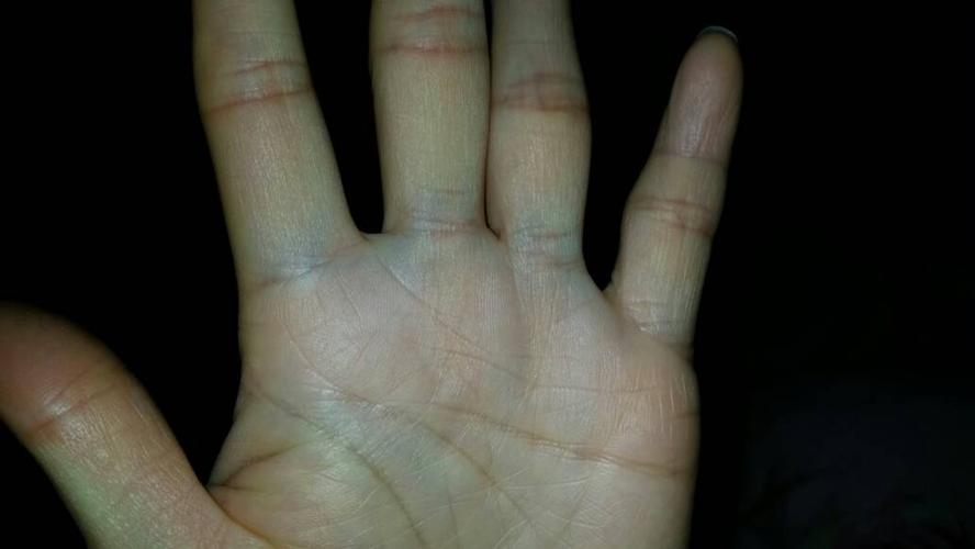 手指根为什么突然发青
