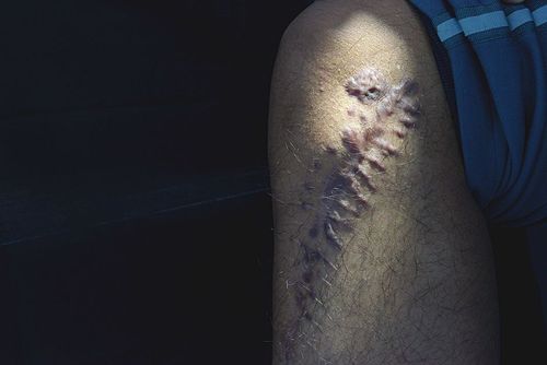 6年吸毒史,毒驾时迎面撞上大货车,轿车报废,腿险些被撞断.