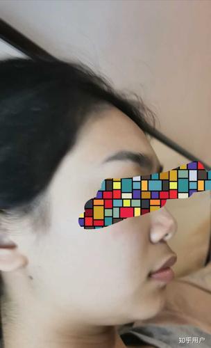 上嘴唇上翘,上翻怎么办?侧面看起来简直丑哭我!