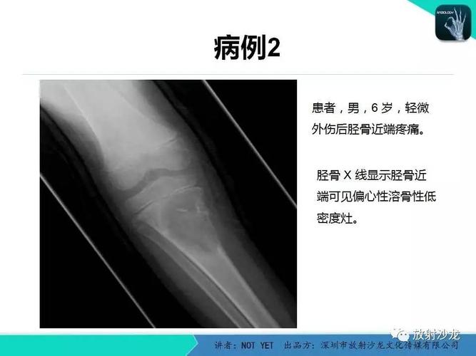 【每日一例 405期】动脉瘤样骨囊肿
