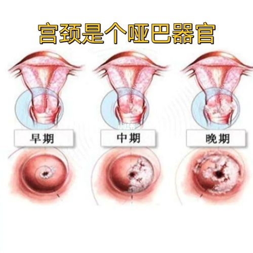 宫颈是个哑巴器官_世界知音攻略_医疗健康_医疗健康