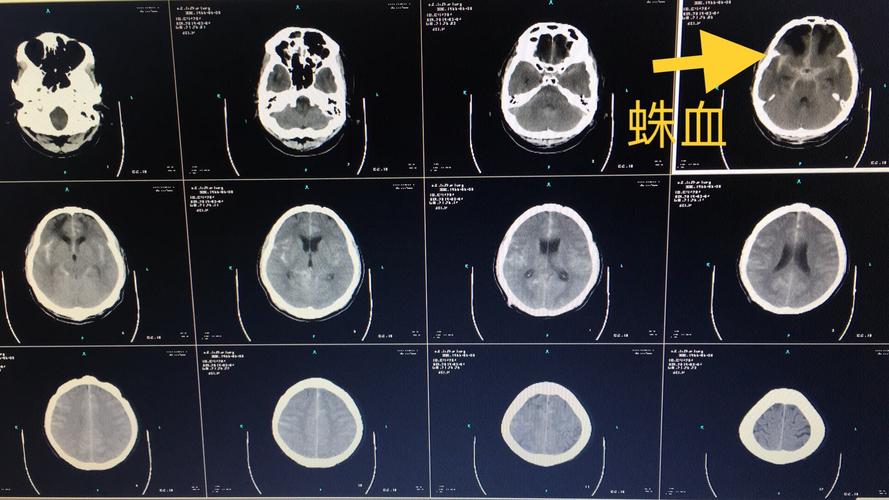 术前ct提示蛛网膜下腔出血