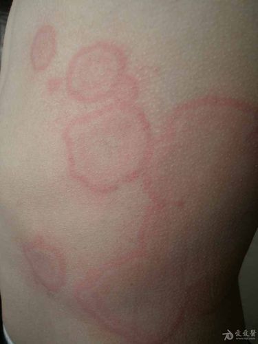 猜☆图☆病☆例☆(47)答案:离心性环状红斑,前5名回答准确均加分.