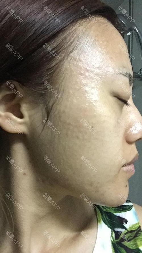 水光补水好不好_效果图_你好漂亮oo水光补水术后第0天_新氧美容整形