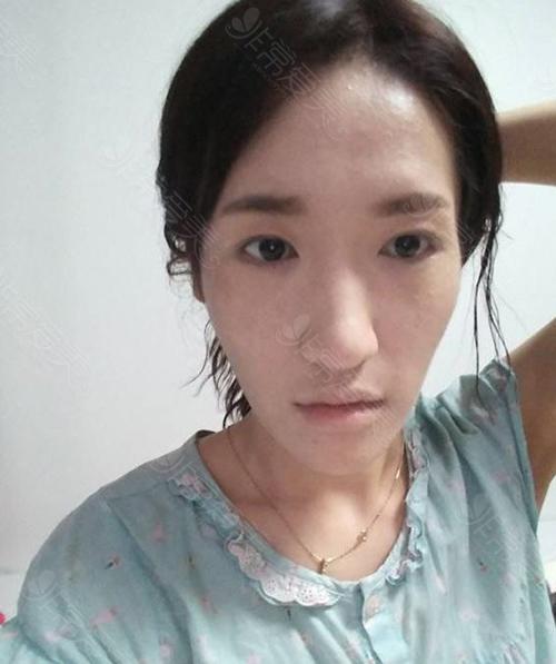 韩国eu整形外科长脸双鄂手术真人案例公开术后效果超惊艳