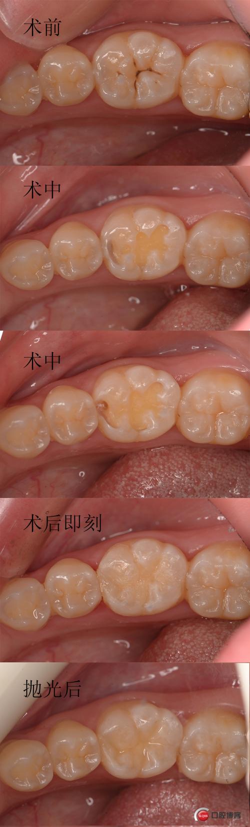 遮色做的不够好,颜色有一点偏深,慢慢改进[详细]前牙树脂补牙林炜