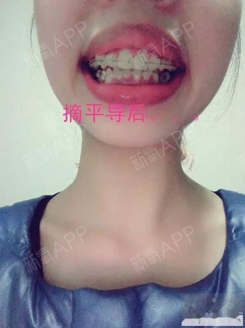 牙套中-平导前后对比图