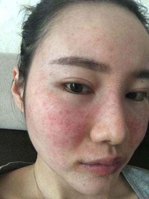 一般这种情况主要是由于质细胞堵塞了毛囊皮脂腺口角,这样就会使得