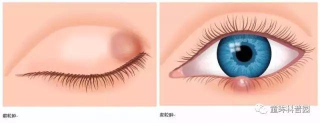 霰粒肿or麦粒肿你还傻傻分不清楚