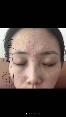 脸部问题之三十岁以后还长痘痘