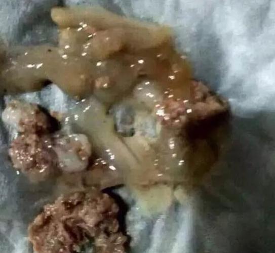 5,排出的瘀毒是毛肚状,有可能是子宫内膜炎,盆腔炎.