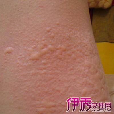 【图】皮肤荨麻疹图片大全 皮肤荨麻疹十大病因有哪些