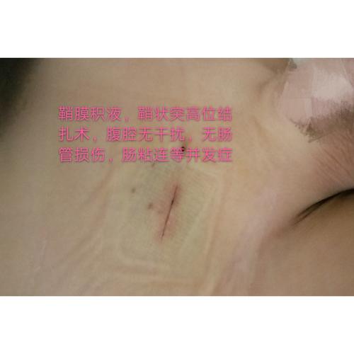 小切口鞘膜积液,鞘状突高位结扎术术后