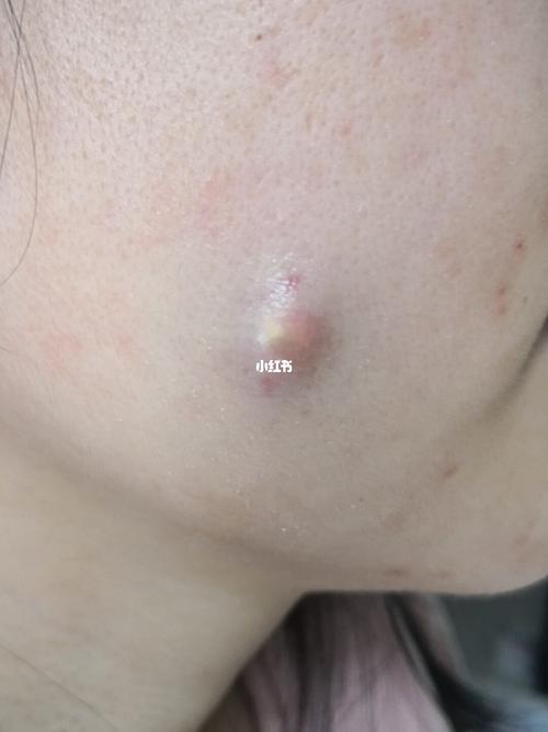 面部钙化上皮瘤(毛母质瘤)治疗全过程_疤痕_整形_协和