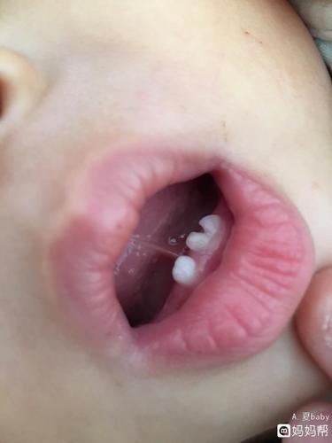 宝宝牙齿