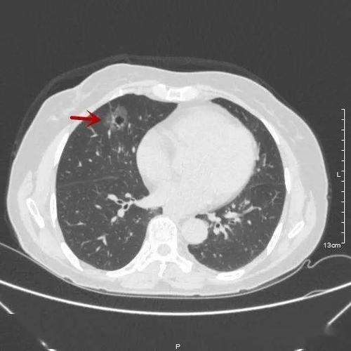 病例分享:大家来瞧瞧,典型而漂亮的囊腔型肺癌!