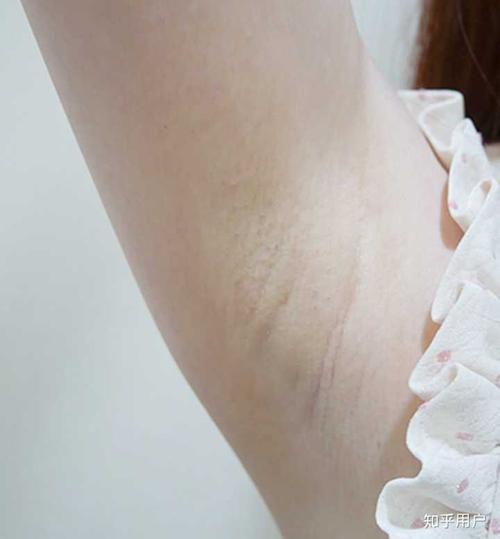 请问腋下和私处怎样把腋毛脱干净而且能去掉黑色素