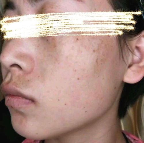 色斑不仅容易长在鼻梁上,也会在眼角周围,在脸颊两侧,甚至额头,下巴