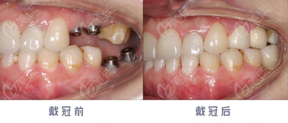 济南美奥口腔吴高义做种植牙靠谱么种牙病例及评价可以证明哦