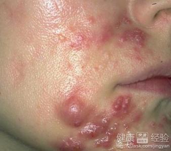 皮脂腺囊肿总复发是什么原因