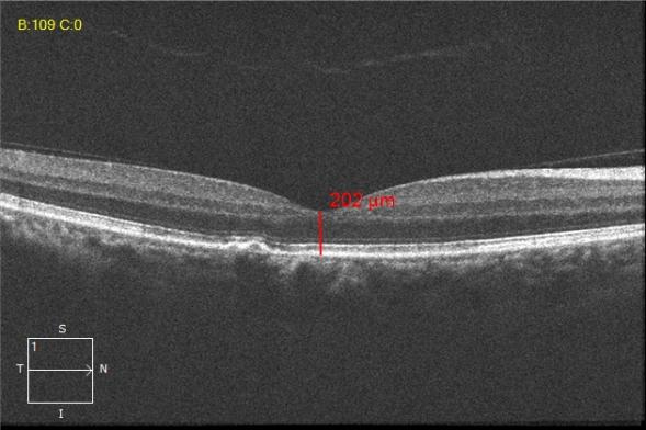 眼科专家彭志华指出沃丽汀是治疗中浆病的理想方案之一
