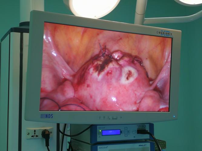 腹腔镜下子宫肌瘤剔除