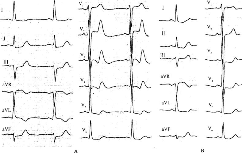 第三节 不稳定型心绞痛-冠心病心电图-医学